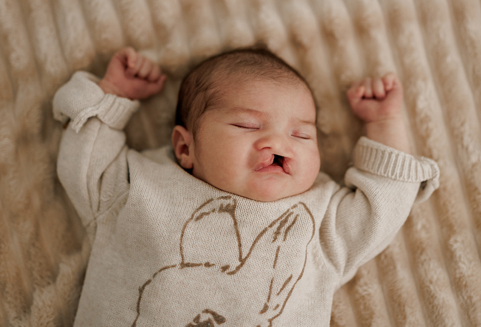 Baby met aangeboren afwijking schisis lip.