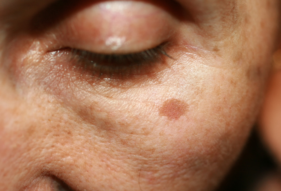 Zmack Dermatochirurgie Huidvlek portret vrouw
