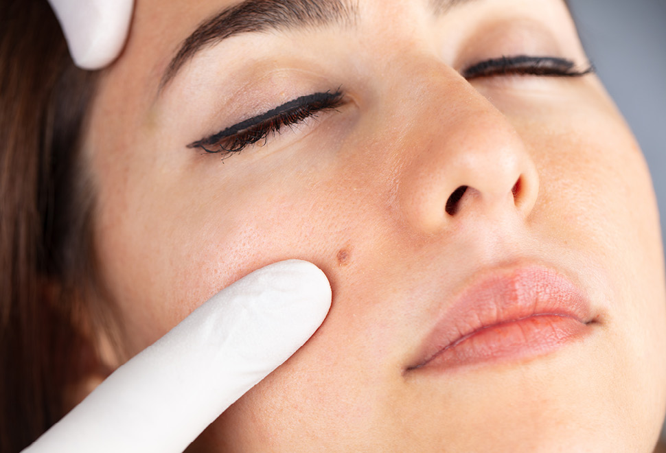 Zmack Dermatochirurgie Vlek Aangezicht Vrouw