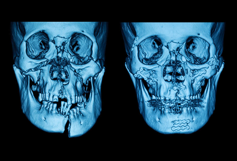 Zmack traumatologie schedels fractuur röntgon